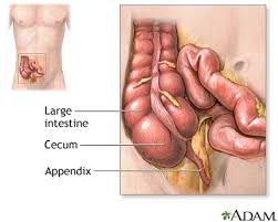 Appendectomy