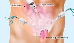 Hernia Repair